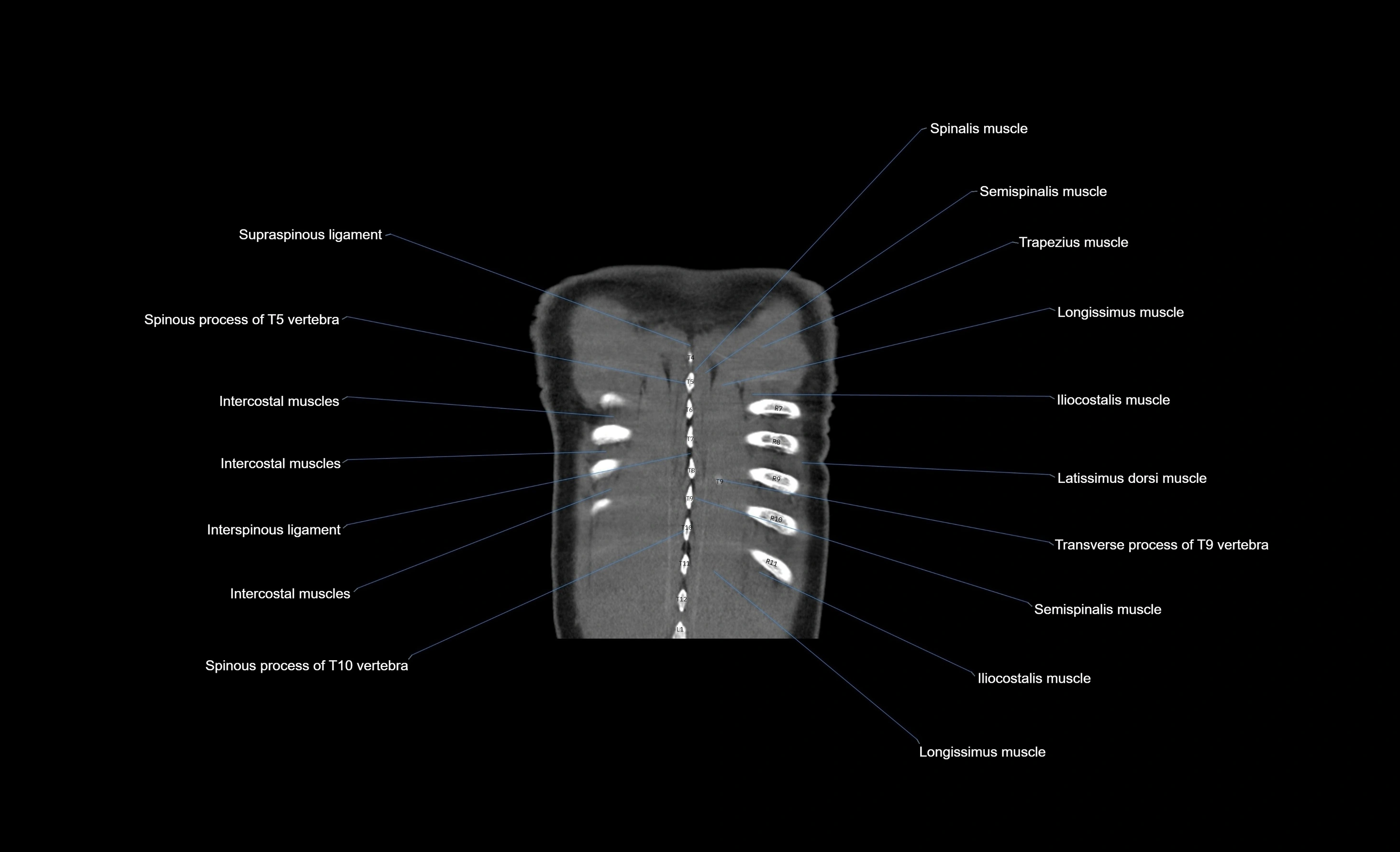 CT chest (thorax) soft tissue window labelled coronal cross sectional anatomy radiology image-00011.webp